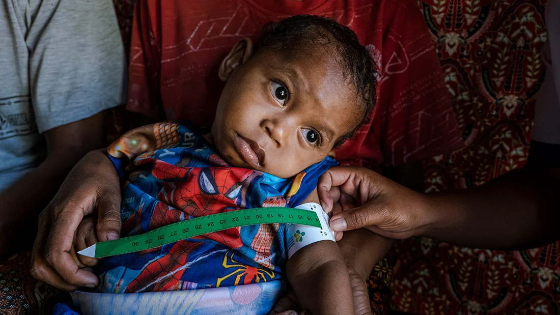 Child suffering from malnutrition.