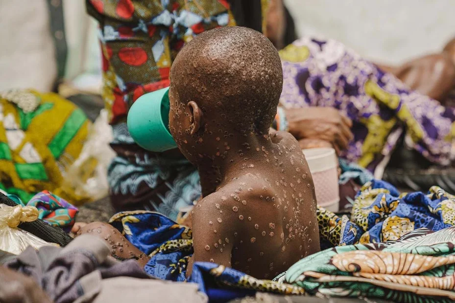 Ein an Mpox erkranktes Kind in der Mpox-Isolierstation eines von UNICEF unterstützten Spitals in der Provinz Süd-Kivu, in D.R.Kongo, am 23. Juli 2024.